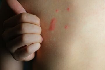 foto morso e puntura da cimice